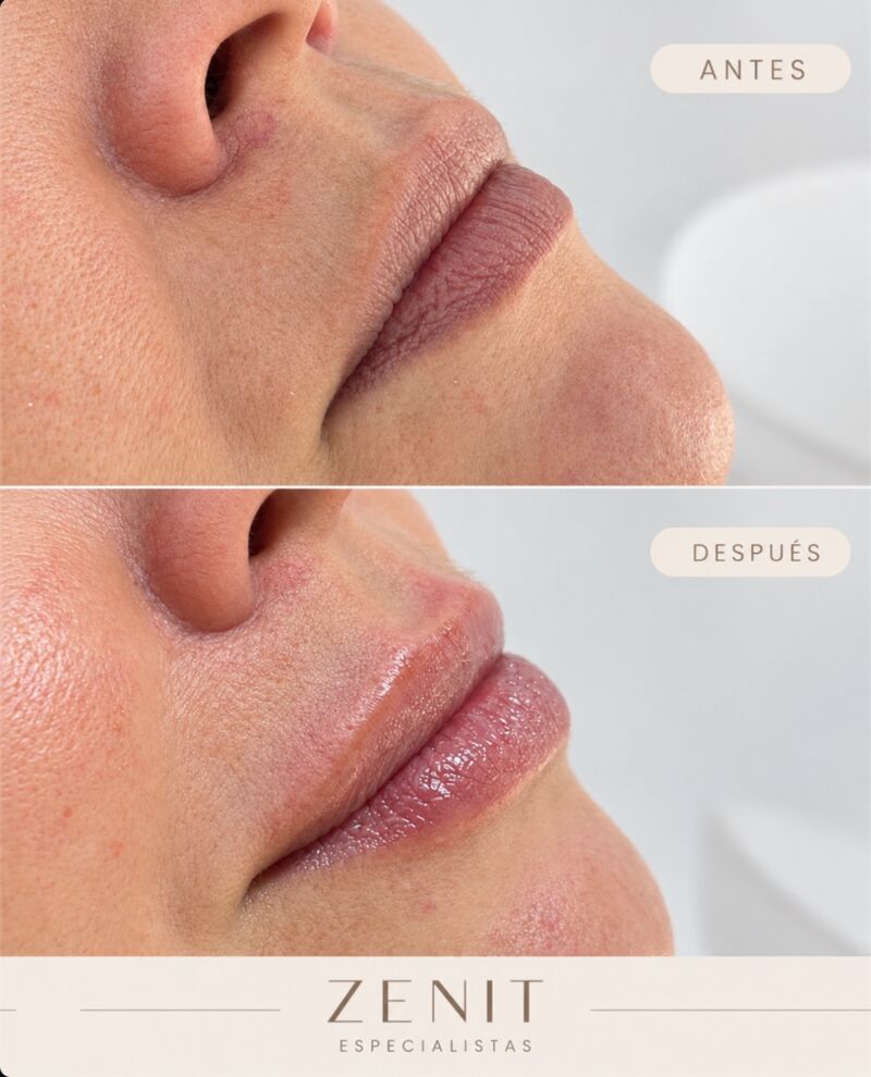 Antes y después: relleno de labios